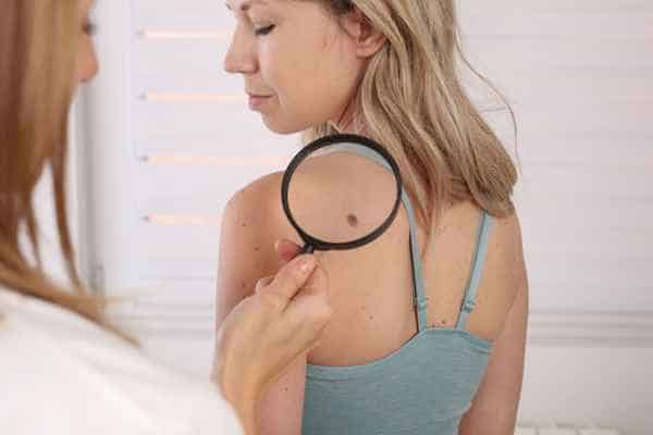 What Are Traditional Skin Lesion Removal Methods Worthing?