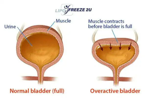 diagram of overactive bladder treatment Worthing