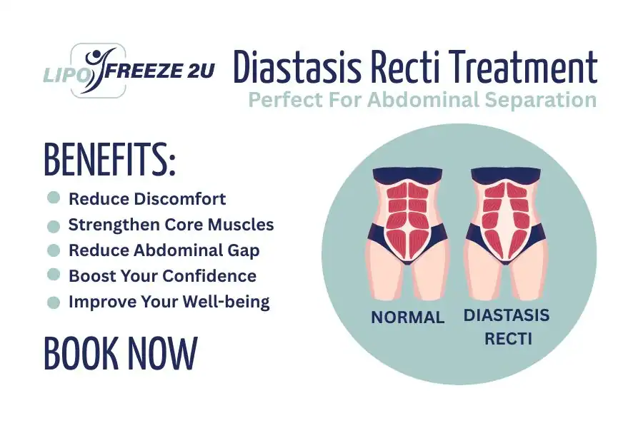 How Long Will It Take to See Improvements in Diastasis Recti Worthing