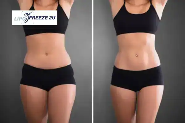 How Can LIPO FREEZE 2U Support Your Post-Pregnancy Body Recovery Worthing?
