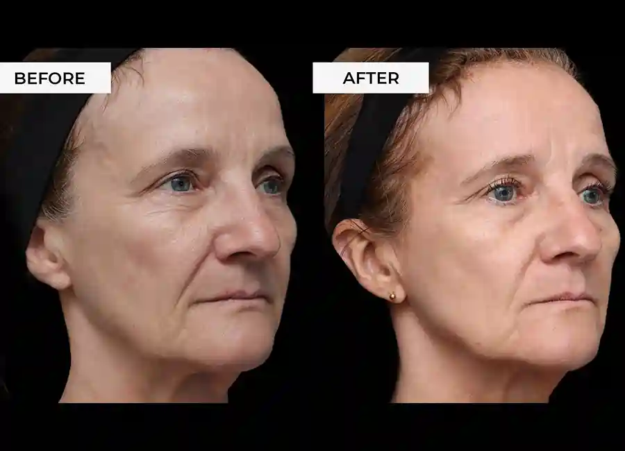 How Many RF Microneedling Sessions Will You Need to See a Difference Worthing?