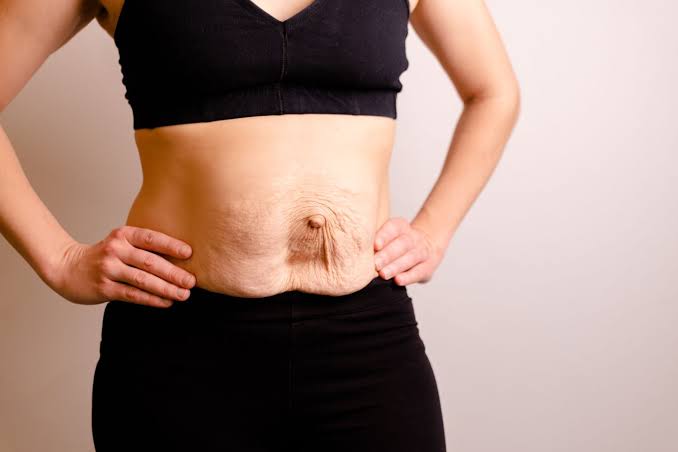 Is Surgery Really the Only Way to Repair Diastasis Recti Worthing?