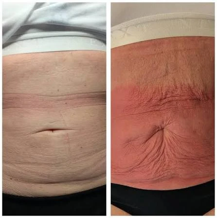 How Does RF Microneedling Improve Crepey, Thin and Uneven Skin Texture Worthing?