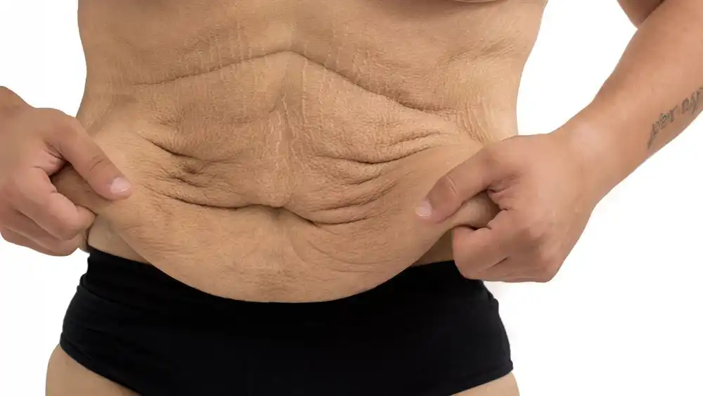 Why Does Weight Loss Medication Leave Some People With Loose or Sagging Skin Worthing?